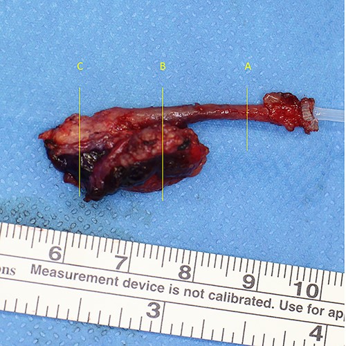 Extracted fistula and cyst. A, B, C indicate cross-sections for histology.