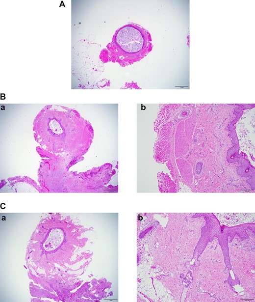 (A) Section at A in Fig. 6. ×2 objective lens. The fistula wall consists of squamous cells. The lumen is filled with cornified material. (B-a) Section at B in Fig. 6. ×2 objective lens. Many hair follicles can be seen. Adjacent to the fistula, chronic inflammation is observed. (B-b) Section at B in Fig. 6. ×10 objective lens. The fistula is surrounded by skeletal muscle. (C-a) Section at C in Fig. 6. ×2 objective lens. At this section level, the fistula is not accompanied by muscles. (C-b) Section at C in Fig. 6. ×10 objective lens. Long hair follicles and glands can be observed.
