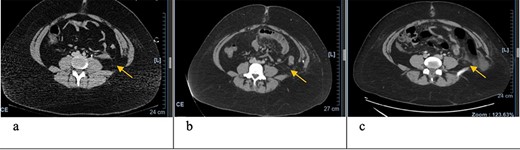 Axial CT scan with arrows pointing to internal and external oblique defects in June (a), August (b) and September (c); panel (a) shows rupture between internal and external oblique muscles at the attachment point of the quadratus lumborum; panel (b) shows fat stranding, suggesting inflammation of the epiploic appendage, and may be an early sign of delayed traumatic wall hernia; panel (c) shows herniation through the muscular defect.