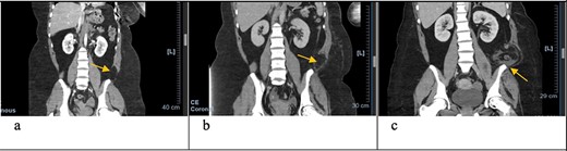 Coronal CT scan with arrows pointing to internal and external oblique defects in June (a), August (b) and September (c); panel (a) shows rupture between internal and external oblique muscles at the attachment point of the quadratus lumborum; panel (b) shows fat stranding, suggesting inflammation of the epiploic appendage, and may be an early sign of delayed traumatic wall hernia; panel (c) shows herniation through the muscular defect, with the descending colon without obstruction.