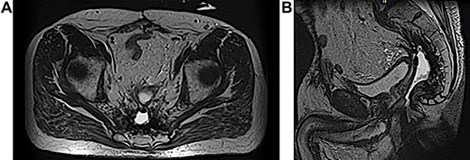 (A and B) MRI abdomen and pelvis demonstrating 2–3 cm pelvic sinus cavity with connecting tract to the perineum.