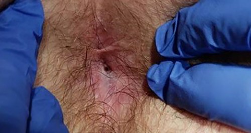 Physical exam in office showing perineal wound with sub-centimeter cutaneous opening.