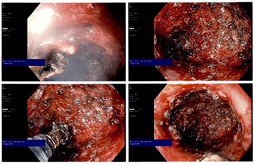 Intraoperative endoscopic photographs showing cauterized cavity epithelium.
