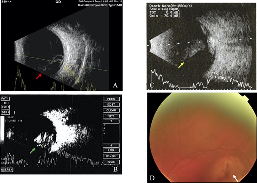 Intravitreal foreign body; (A) B-scan ultrasound revealed vitreous hemorrhage with retinal detachment in Case 6 (red arrow), (B) vitreous hemorrhage in Case 7 (green arrow), (C) vitreous hemorrhage with retinal detachment of the LE in Case 9 (yellow arrow), (D) fundus examination showed hazy vitreous with a retinal tear (white arrow) near superior temporal arcade of the retinal artery (Case 9).