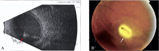 Intraretinal foreign body; (A) B-scan ultrasound revealed hazy vitreous with absence of retinal detachment and high reflective intravitreal object (red arrow), suggestive of metallic IOFB and endophthalmitis (Case 3), (B) Fundus examination showed a foreign body at inferior temporal quadrant of the LE (white arrow), with intraretinal hemorrhage (Case 4).