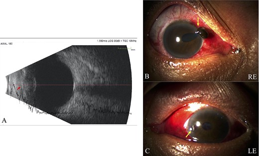 Intralenticular foreign body; (A) B-scan ultrasound confirmed lens opacity, intact posterior capsule and suspected lenticular IOFB (red arrow), with normal vitreous and retina of the RE (Case 5), (B) Slit lamp bio-microscopy revealed corneal rupture and iris prolapse (Zone I) at 2 o’clock limbal, flat AC and traumatic cataract on the RE, (C) corneal rupture (Zone I) at 9 o’clock paracentral, shallow AC and traumatic cataract on the LE were discovered in Case 8 (yellow arrow).