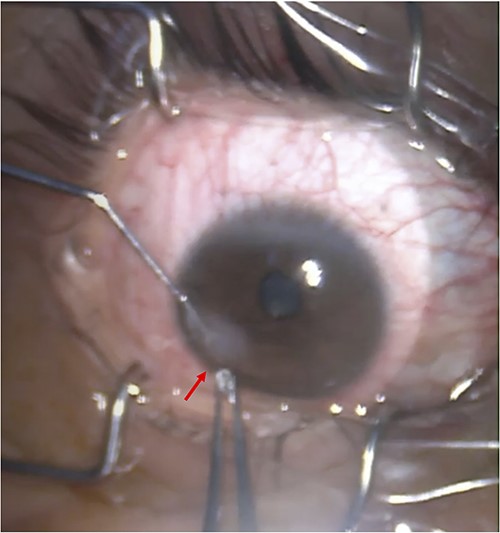 Intracorneal foreign body; a glass fragment in the size of 1 × 1 mm was embedded in the RE cornea and was completely removed using forceps (Case 1).
