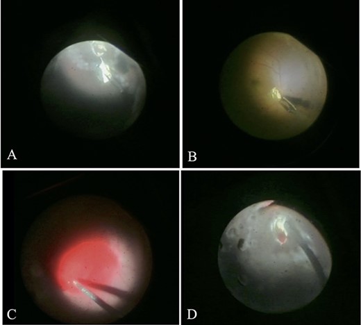 Difficulties during the IOFB extraction in Case 4; (A) A large size metallic iron IOFB was embedded in retina and a retinal break was discovered at inferior temporal, after applied laser barrage to secure the break, the IOFB was removed, (B) The IOFB fell twice on to the retina, but it was successfully removed by scleral incision using IOFB forceps, shown as a metallic object with the size of 3 × 5.5 mm, (C) Retinal hemorrhage after removal was showed and the hemorrhage was managed, (D) One iatrogenic break at perimacular area was found during the removal and caused additional hemorrhage in the vitreous; the hemorrhage was controlled, laser barrage was applied and silicon oil 1000 c was injected as tamponade.