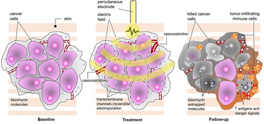Overview of mechanism of action of electrochemotherapy. The procedure combines the injection or infusion of a cytotoxic drug (bleomycin or cisplatin) with the local application of short, high-voltage electric pulses, and the combined result is the enhancement of chemotherapy diffusion into the tumour thanks to the transient opening of aqueous pores on the cell membrane (reversible electroporation); since dividing cells are sensitive to chemotherapy, ECT provides the ability to selectively kill tumour cells (predominantly by drug-induced double-strand DNA breaks and apoptosis, although some necrosis also occurs) without harming normal surrounding tissue, and additional mechanisms of action include immediate local vasoconstriction (reduced drug washout), delayed endothelial disruption (leading to lack of oxygen and nutrients) and immune response to released antigens and danger-associated molecular patterns.