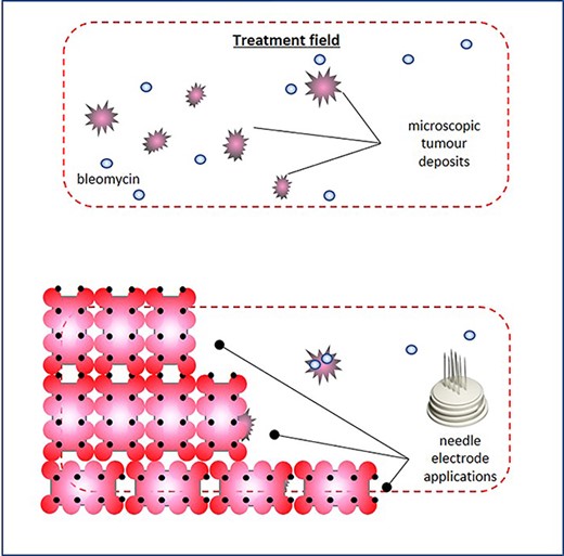 Treatment plan, and the electrochemotherapy field encompassed the skin around the previous surgical scar; following intravenous chemotherapy infusion, coverage of the treatment field was achieved through multiple juxtaposed insertions of a linear array needle electrode, and electrode overlapping or reapplication on the same area was carefully avoided to prevent tissue ischaemia; to avoid injuring the underlying prosthetic implant, the maximum needle depth did not exceed 5 mm.