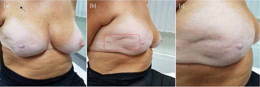 Treatment outcome; at 5-year follow-up, the patient is disease-free, with no evidence of local recurrence or long-term toxicity. The prosthetic implant remains in situ, providing satisfactory symmetry and aesthetic outcome: (a) overview; (b) treatment field of electrochemotherapy; (c) closeup on the treated skin.