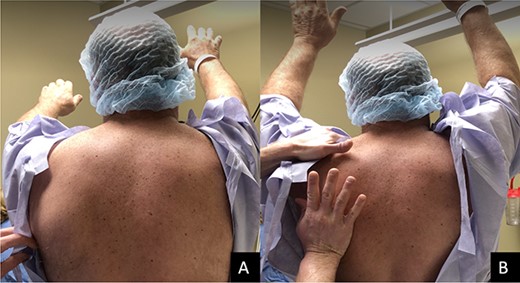 (A) Limited forward flexion to 90° with significant inferior and lateral to the spine when compared with the right scapula. (B) Forward shoulder flexion to about 180° with forced reduction on the scapula.