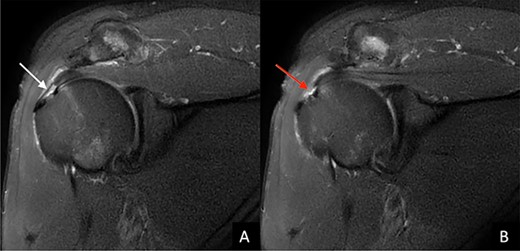 T2-weighted coronal MRI image of the left shoulder shows (A) the degree of medial to lateral involvement (white arrow) of (B) the full thickness tear of the distal portion of the supraspinatus tendon.