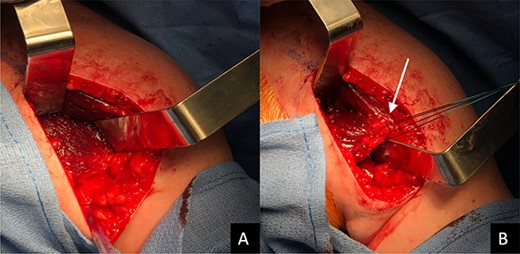 Intraoperative photograph showing the surgical exposure using the deltopectoral approach (A). The pectoralis major muscle is identified and tagged, demonstrated by the white arrow (B).