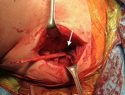 Intraoperative photograph shows the tibialis anterior graft with the Pulvertaft weave onto the pectoralis major. The white arrows show the insertion of the tibialis anterior graft onto the pectoralis major muscle.