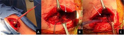Intraoperative photograph shows the semi-T whipstitched graft at full length (A). The white arrow in (B) shows the 9-mm hole drilled in the inferior border of the scapula. The white arrow in (C) shows the semi tendinosis transferred through the whole and tied to itself with #2 FiberWire®.
