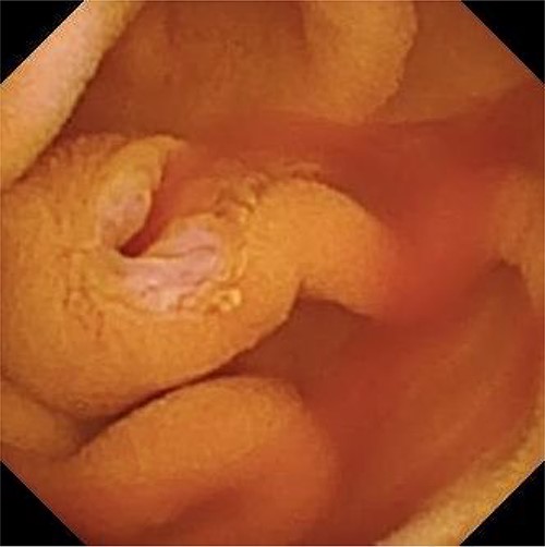 Capsule endoscopy showing fresh blood from an otherwise normal appearing ampulla of Vater.