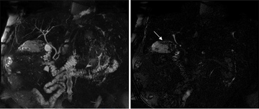 MRCP showing a normal appearing biliary tree (left), but an abnormal appearing gallbladder with numerous gallstones and a space-occupying process (right marked by arrow) involving the posterior wall.