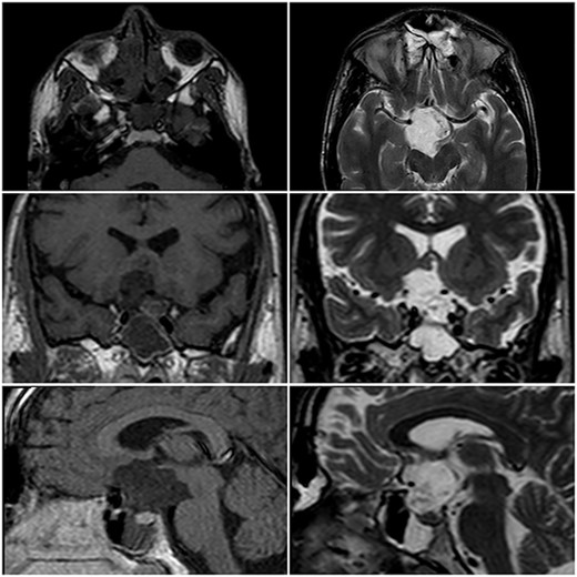 MRI in axial, coronal and sagittal views. The lesion appears with hyposignal in T1WI and hypersignal in T2WI.