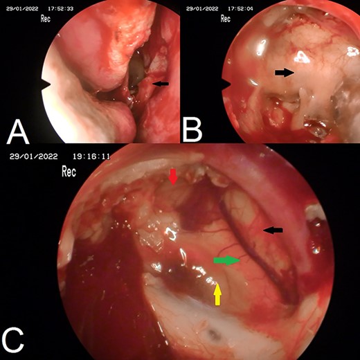 Endoscopic images. (A) nasoseptal flap; (B) posterior bony wall of sphenoid sinus; (C) complete resection of epidermoid cyst, green arrow: optic chiasm, yellow arrow: pituitary gland, red arrow: internal carotid artery, black arrow: anterior brain.