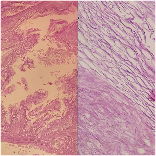 Histological examination of cyst contents. Haematoxilin-eosin stain. Keratin flakes.