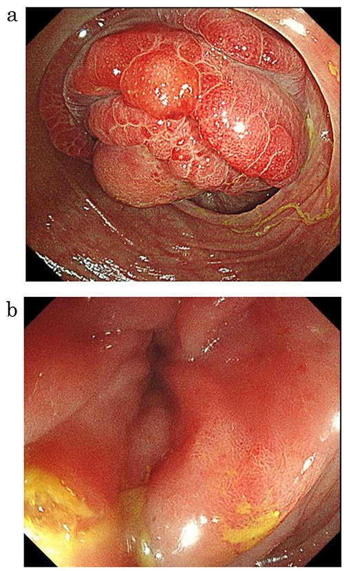 Lower gastrointestinal endoscopy showed a mass with circumferential stenosis in the ascending colon (a), and its surface showed vascular congestion without malignant findings (b).