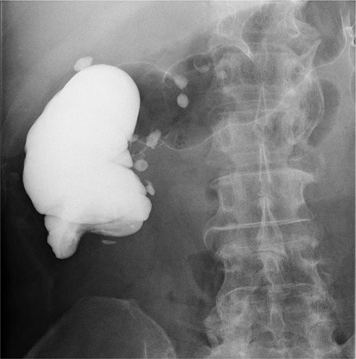 Enema colonography showed complete stenosis.