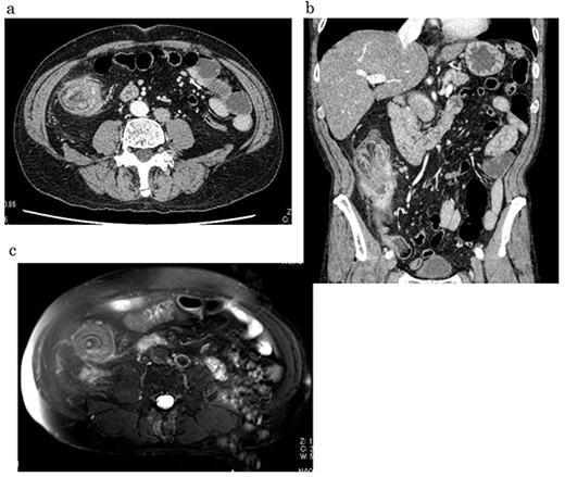 Contrast-enhanced CT/MRI showed increased wall thickness from the ileocecal region to the ascending colon (a, b), which was accompanied by a ring-shaped and layered appearance of the mucosal and muscular layers (c).