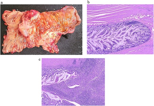 Resected specimen and photomicrographs of the pathology (a) The cecum and ascending colon showed remarkable diverticulitis that was accompanied by prominent wall thickening; the cecum was considered to be the front component of intussusception, and the internal lumen was stenotic due to organization (b, c) Pathological examination revealed the presence of abscess formation due to chronic diverticulitis and penetration by the diverticulum.