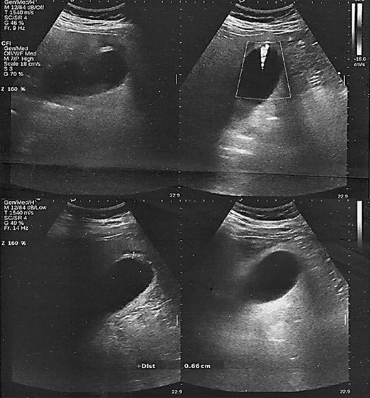 Ultrasound scan. Gallbladder wall thickening without the presence of pericholecystic fluid or gallstones.
