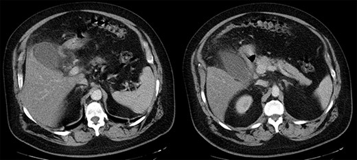 Abdominal CT scan. Marked gallbladder dilatation and wall thickening, combined with free peritoneal fluid and pericholecystic omental involvement.