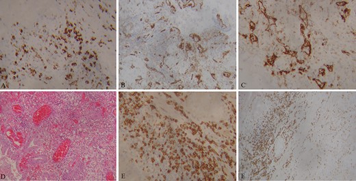 Images of immunohistology staining of gallbladder specimen. CD68 macrophages and fibroblasts (A). CD31 Medium-sized vessels with local inflammatory infiltrations (B, C). Hematoxylin–eosin-stained sections of the gallbladder; inflammatory infiltrates diffusely involve medium-sized vessels, with lumen obliteration (D). CD4 Lymphocytes (E, F).