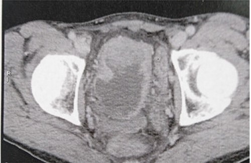 CT revealing a bladder tumor of 5 × 5 cm over the dome and anterior wall.