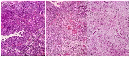 Microscopic overview of the malignant urothelial tumor with sarcomatoid and rhabdomyoblastic components (hematoxylin and eosin * 20).