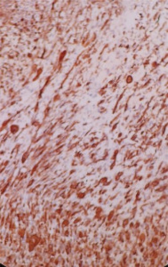 Immunohistochemical (IHC) study shows the positivity of rhabdomyoblastic cells to the anti-desmin antibody (IHC * 20).