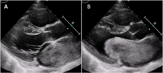 Transthoracic echocardiogram during systole (A) and diastole (B). Giant LA myxoma was prolapsing to the mitral valve orifice.