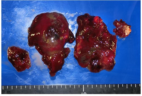 Resected specimen of myxoma.