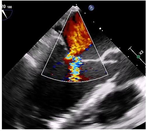 Intraoperative transesophageal echocardiogram after the myxoma resection. Moderate mitral regurgitation with annulus dilatation was detected.