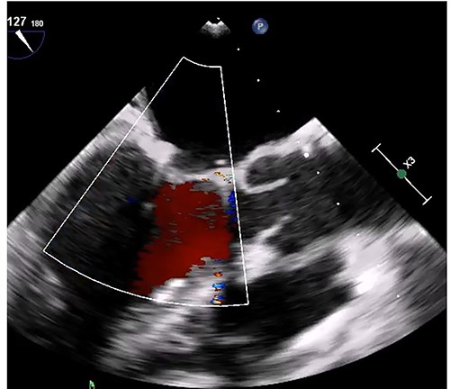 Transesophageal echocardiogram after mitral annuloplasty. There was no residual mitral regurgitation.