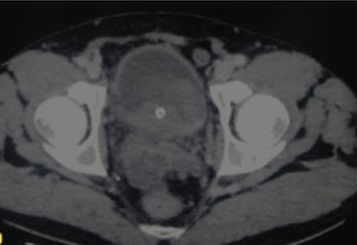 CT revealing a bladder tumor of 6 × 5 cm over the trigone and left wall.