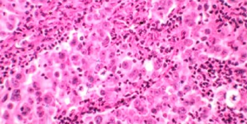 Microscopic aspect of bladder LELC.