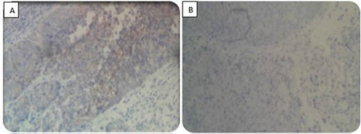 Immunohistochemical study. (A) Positive staining for CKAE1/AE3. (B) Negative staining for CD7 and CD20.