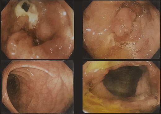 Colonoscopy images showing ulcero-proliferative growth in the cecum and descending sigmoid junction.