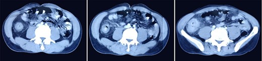 CT images showing segmental asymmetrical circumferential mass-like wall thickening of the cecum and ascending colon over the length of 7.6 cm causing luminal narrowing with enhancing soft tissue extension into the adjacent pericolic fat with loss of fat plane with the right psoas major muscle, pericolic fat stranding along with thickening of adjacent peritoneal lining.