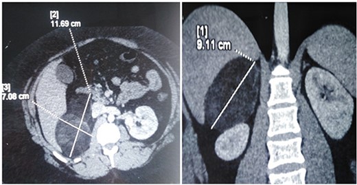 CT scan image showing right adrenal fatty mass.