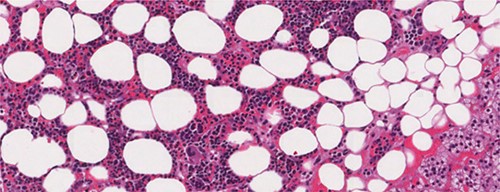 Microscopic appearance of adrenal myelolipoma; typical histological features of a myelolipoma comprising adipose tissue mixed with areas of hematopoietic tissue.
