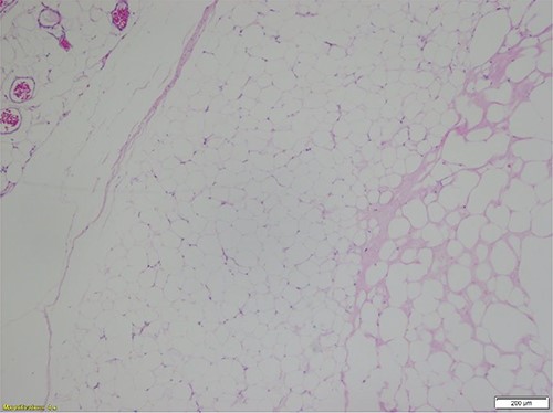 Mature adipocytes of a benign lipoma with relatively scant, septal vascularity and foci of fat necrosis (H&E-stained section; ×40 total magnification: ×4 objective with ×10 ocular lens) (Courtesy Karl Biesemier, MD. Pathology Consultants of Central Virginia, Lynchburg, VA).