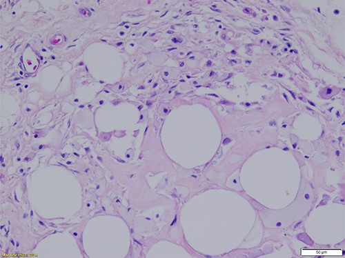 Region of fat necrosis within the benign lipoma. Scattered inflammation and focal degenerative adipocyte changes are seen along with rare microcalcifications (H&E-stained section, ×200 total magnification: ×20 objective with ×10 ocular lens) (Courtesy Karl Biesemier, MD. Pathology Consultants of Central Virginia, Lynchburg, VA).