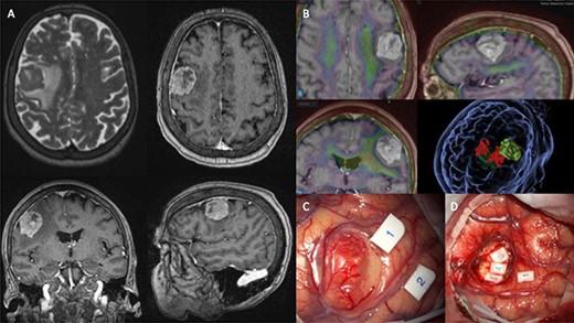 (A) shows MRI sequences (top left) T2 axial, (top right) T1 post gadolinium axial, (bottom) T1 post-gadolinium coronal and sagittal. (B) 3D preoperative modelling and MRI-PET FDG Fusion. Light is tumour and dark green is cortico-spinal tracts. Red dots are positive motor responses – upper and lower limbs – during preoperative motor mapping with navigated transcranial magnetic stimulation. (C and D) show intraoperative microscope images of the tumour (C) and the post-resection tumour cavity (D). Tags 1 and 2 show the motor areas for tongue. At the depth of the tumour cavity (D), tag 3 also represents the motor area for the tongue, while tags 4 and 5 represent the Orbicularis Oris muscle.
