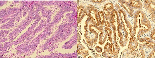 Brain biopsy: (A) Metastatic papillary carcinoma, tall cell variant (haematoxylin-eosin). Papillary growth pattern with delicate branching of papillae. The heights of the tumour cells are at least three times their widths and have apical microvacuolation. (B) Immunohistochemistry for thyroglobulin is positive.